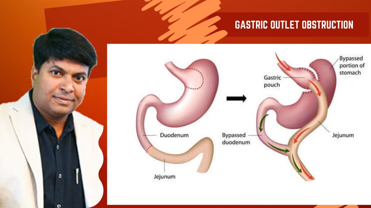 Gastric Outlet Obstruction - Presentation, Complications and Management - Dr Rajamahendran #rrm