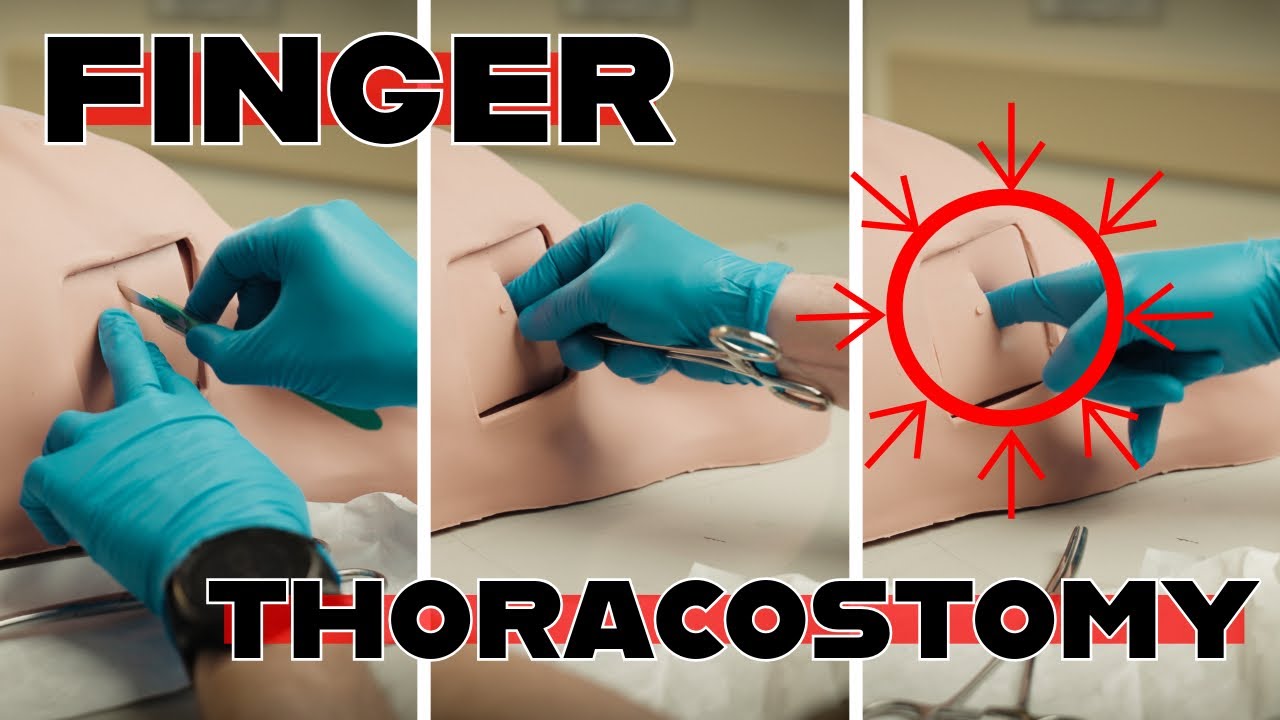 How To: Finger Thoracostomy