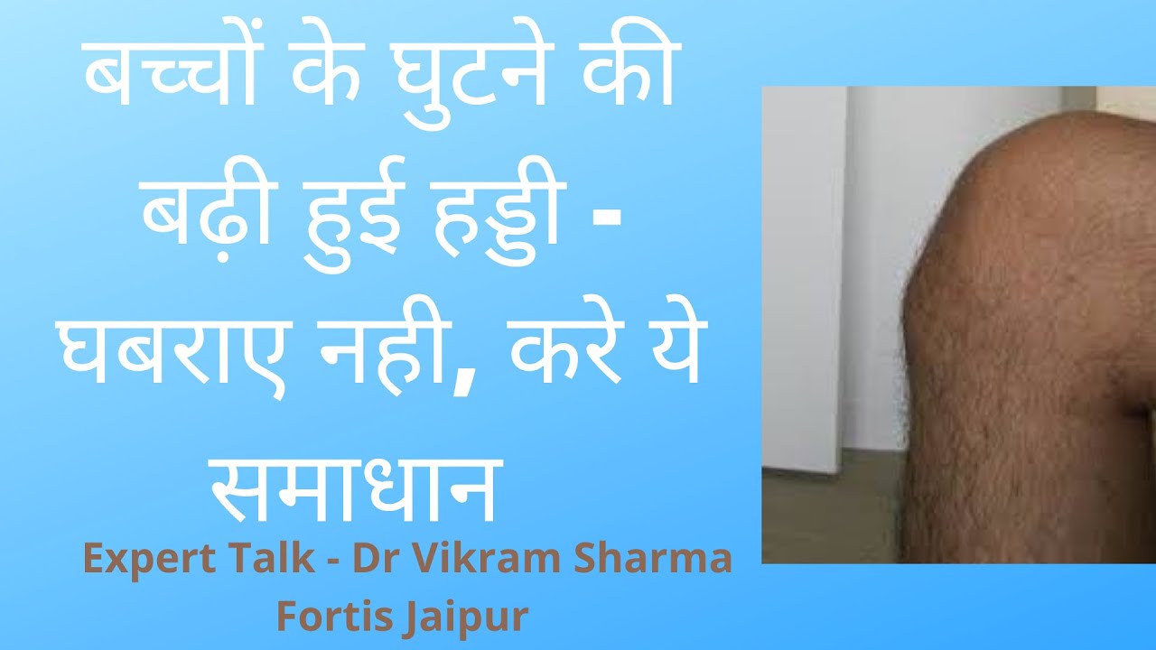 बच्चों के घुटने की बढ़ी हुई हड्डी -घबराए नही, करे ये समाधान  - Dr Vikram Sharma Fortis Jaipur.