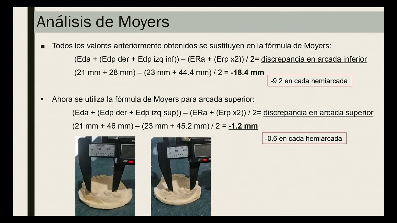 Análisis de Moyers y Nance