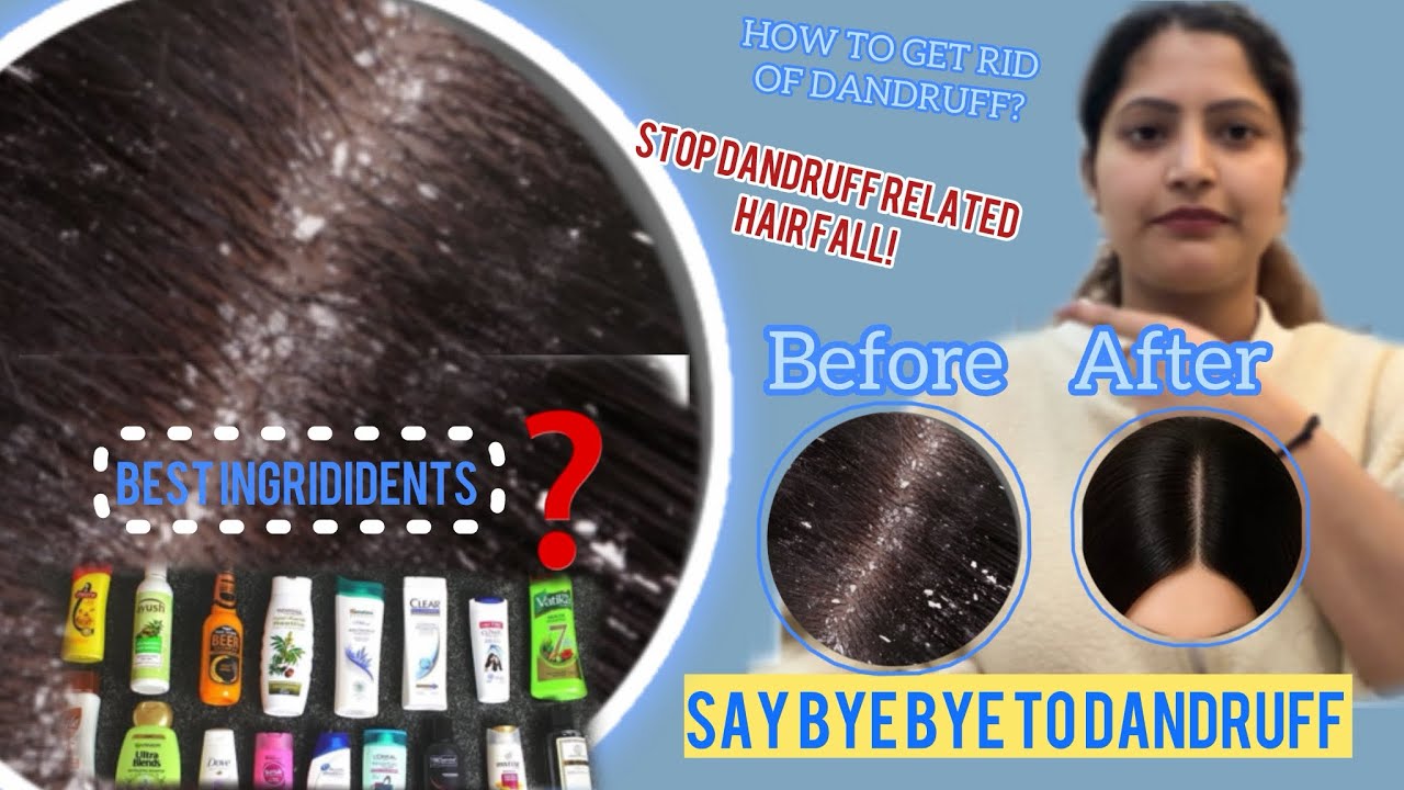 Best anti-dandruff shampoo with visible results in first use | how to get rid of dandruff completely