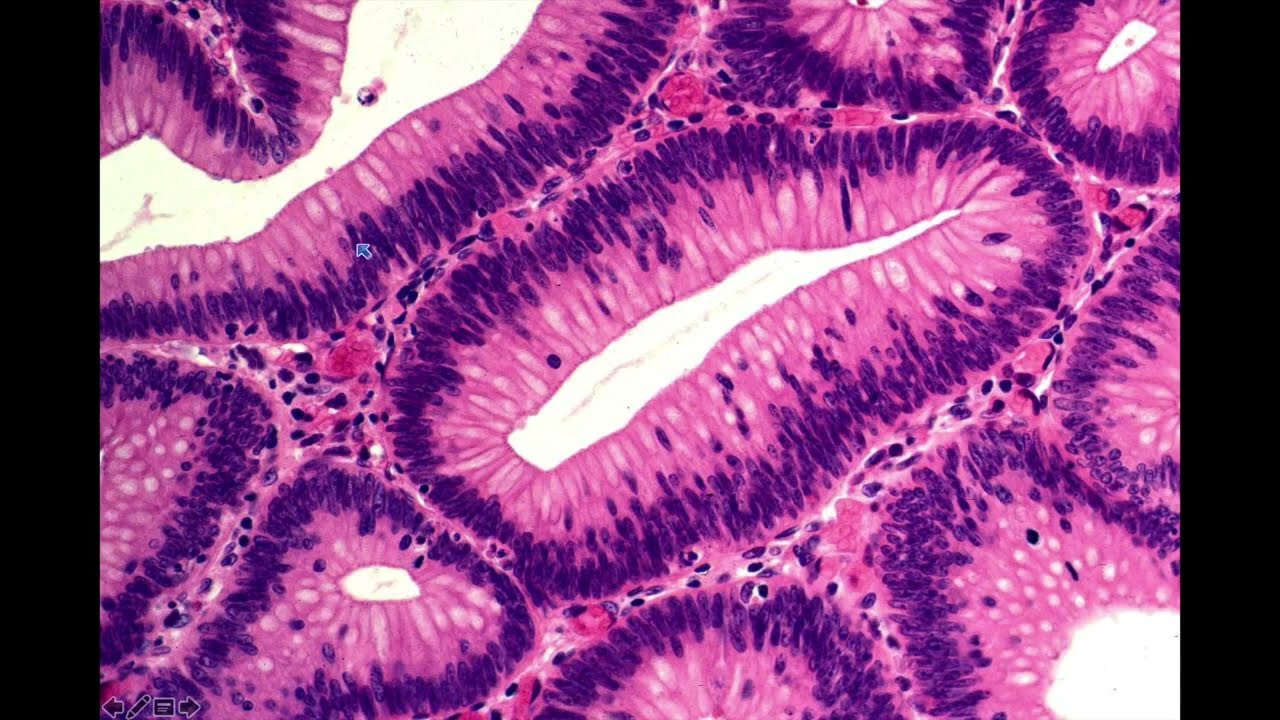 Nomenclature of Colorectal Polyps: Controversies and Confusion by John R. Goldblum, M.D.