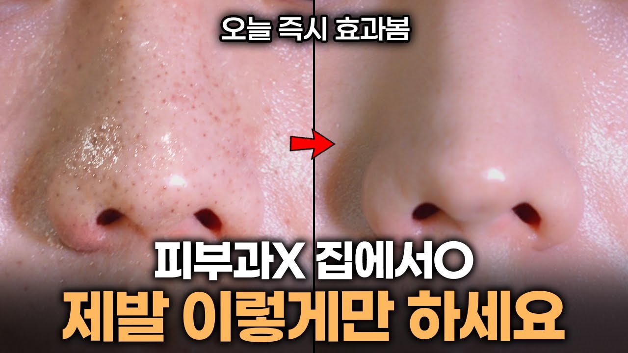 피부과 안가고 블랙헤드 없애는 방법❗ 진짜 쉽고 가장 효과봤던 비밀 알려드릴게요