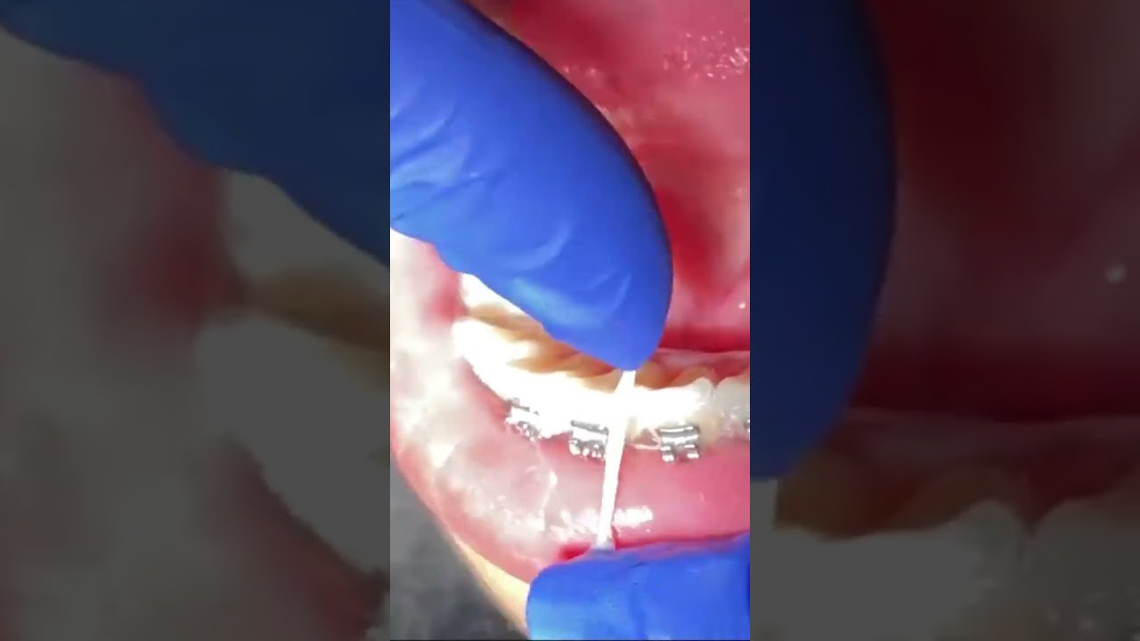 Why did my dentist shave between my teeth? IPR Inter Proximal Reduction Tooth Time Family Dentistry