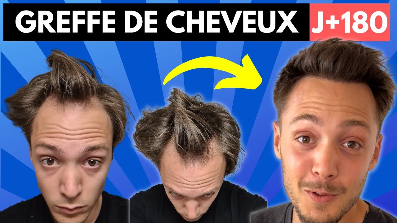 Greffe de cheveux : Il retrouve sa chevelure en seulement 6 mois 😱