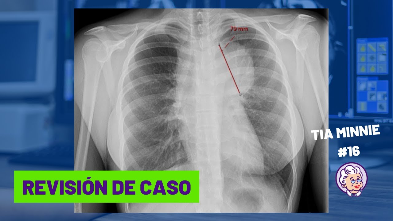 RADIOGRAFÍA DE TÓRAX, UN CASO QUE DEBES CONOCER / TIA MINNIE #16