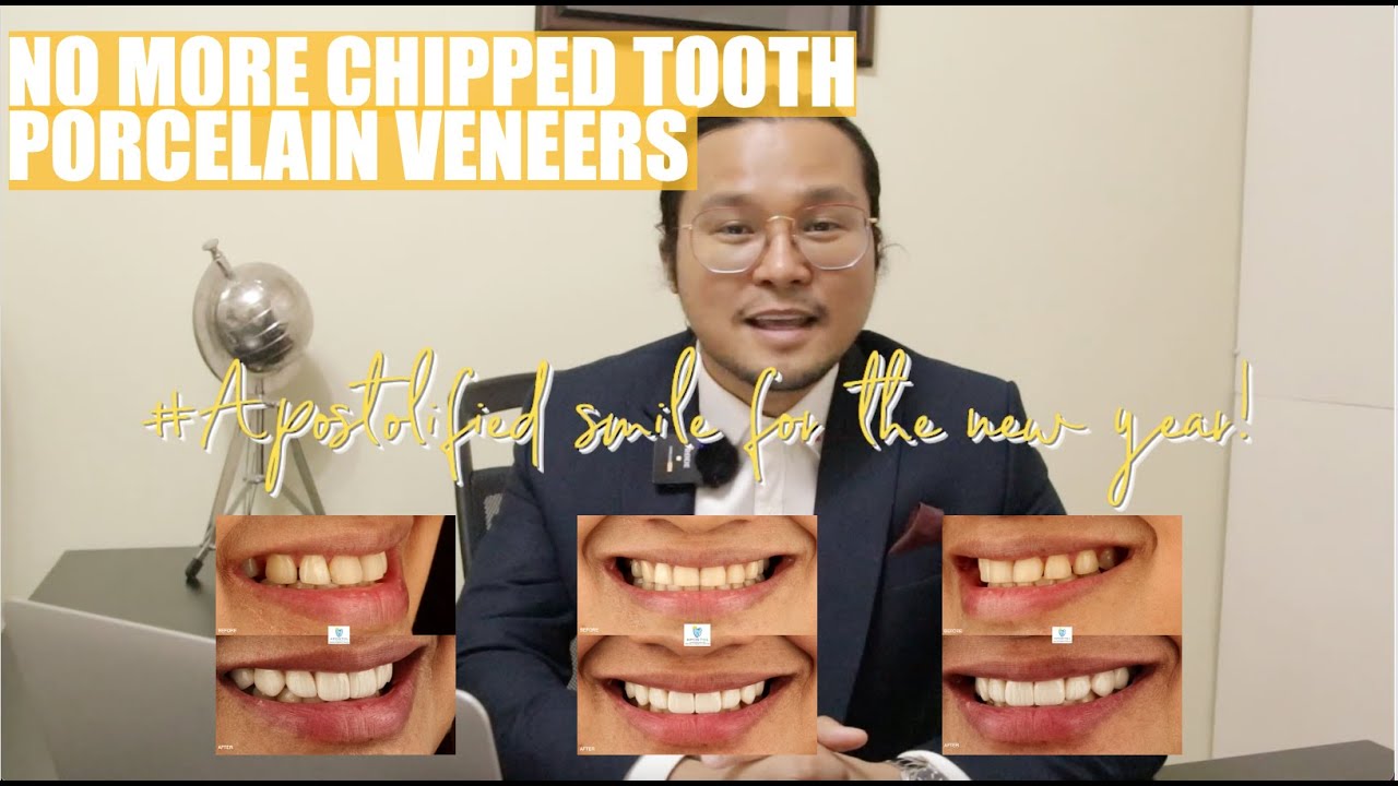 New Year New Smile | Porcelain Veneers | Apostol Dental Philippines