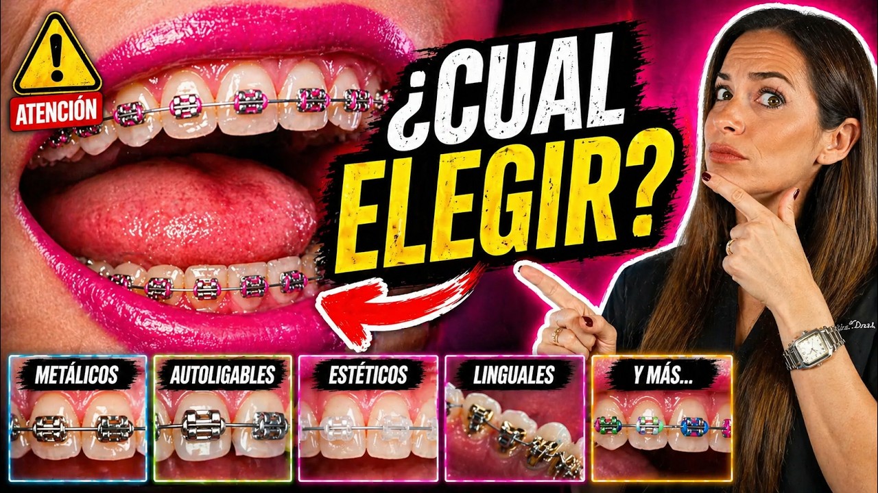 🔴Diferentes 𝗧𝗜𝗣𝗢𝗦 𝗗𝗘 𝗕𝗥𝗔𝗖𝗞𝗘𝗧𝗦  -¿Cual es mejor? (Metálicos, Autoligables, Esteticos y MUCHOS MAS)