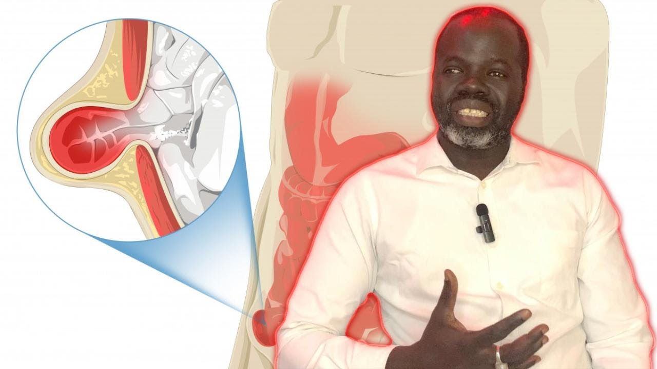 👨‍⚕️Hernie inguinale #1: ( Causes et Symptômes  ) - Pr Ousmane Ndiaye - SAMA XALAAT TV