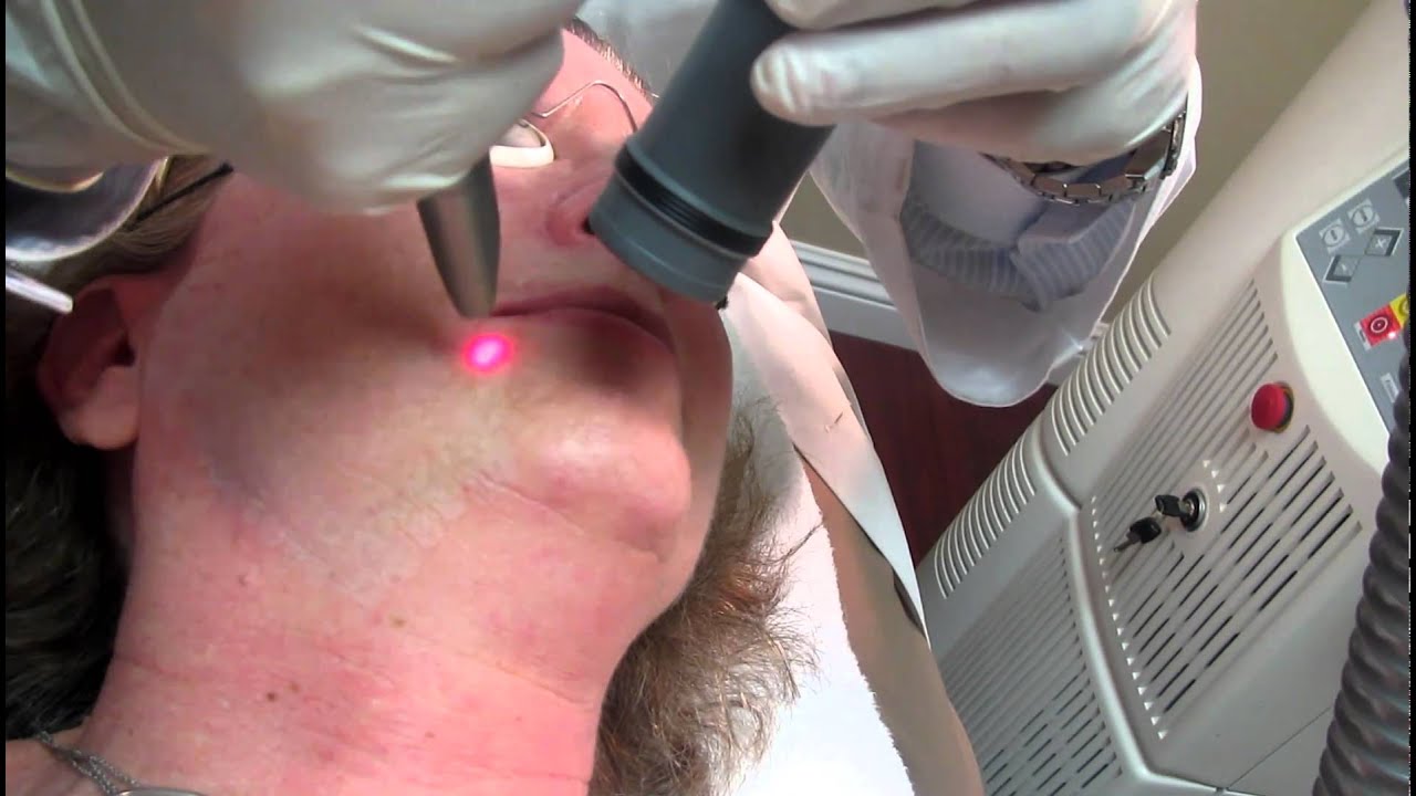 Laser Peel and Skin Resurfacing in Anaheim,New Port Beach,Costa Mesa,Los Angeles and Pasadena