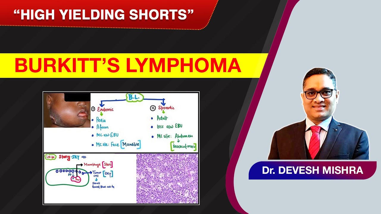 High Yielding Shorts-86 (#HYS-86): Burkitt’s Lymphoma by Dr Devesh Mishra