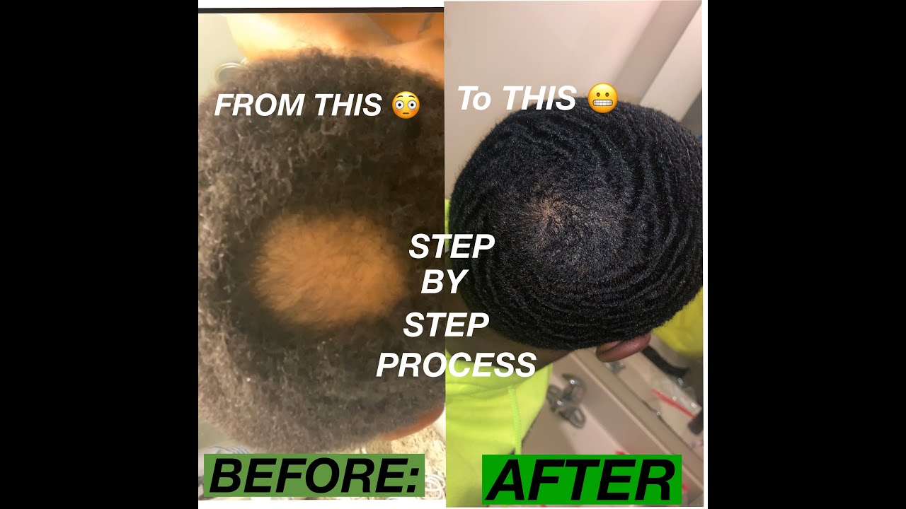 HOW TO GROW A BALD SPOT BACK STEP BY STEP ROUTINE!! PART 2!!!