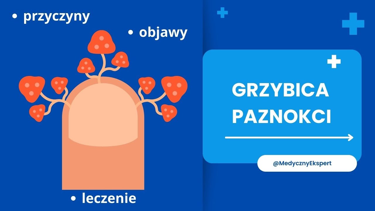 Jak wyleczyć grzybicę paznokci - przyczyny, objawy i leczenie