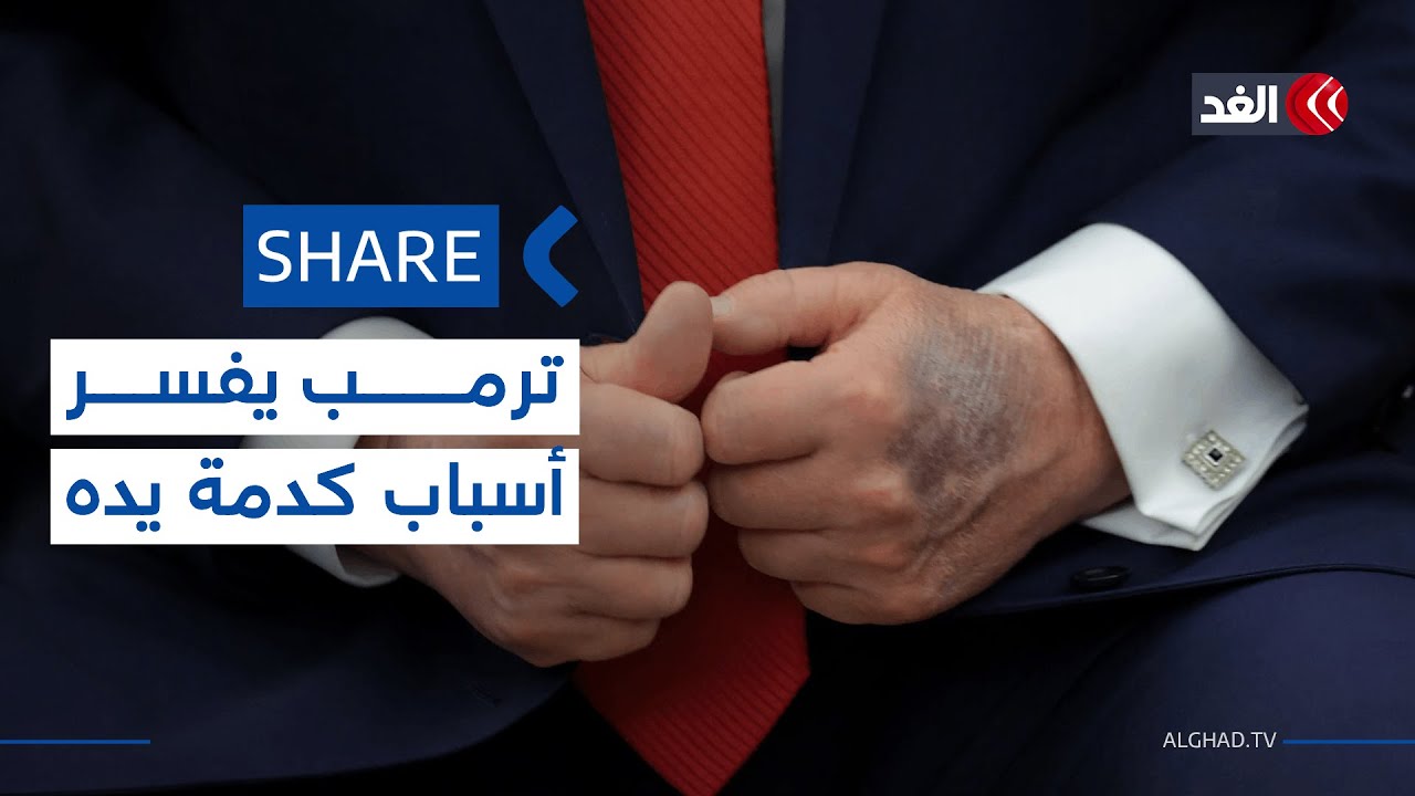 صورة أثارت الجدل.. ترمب يفسر أسباب كدمة يده فماذا قال؟| #شير