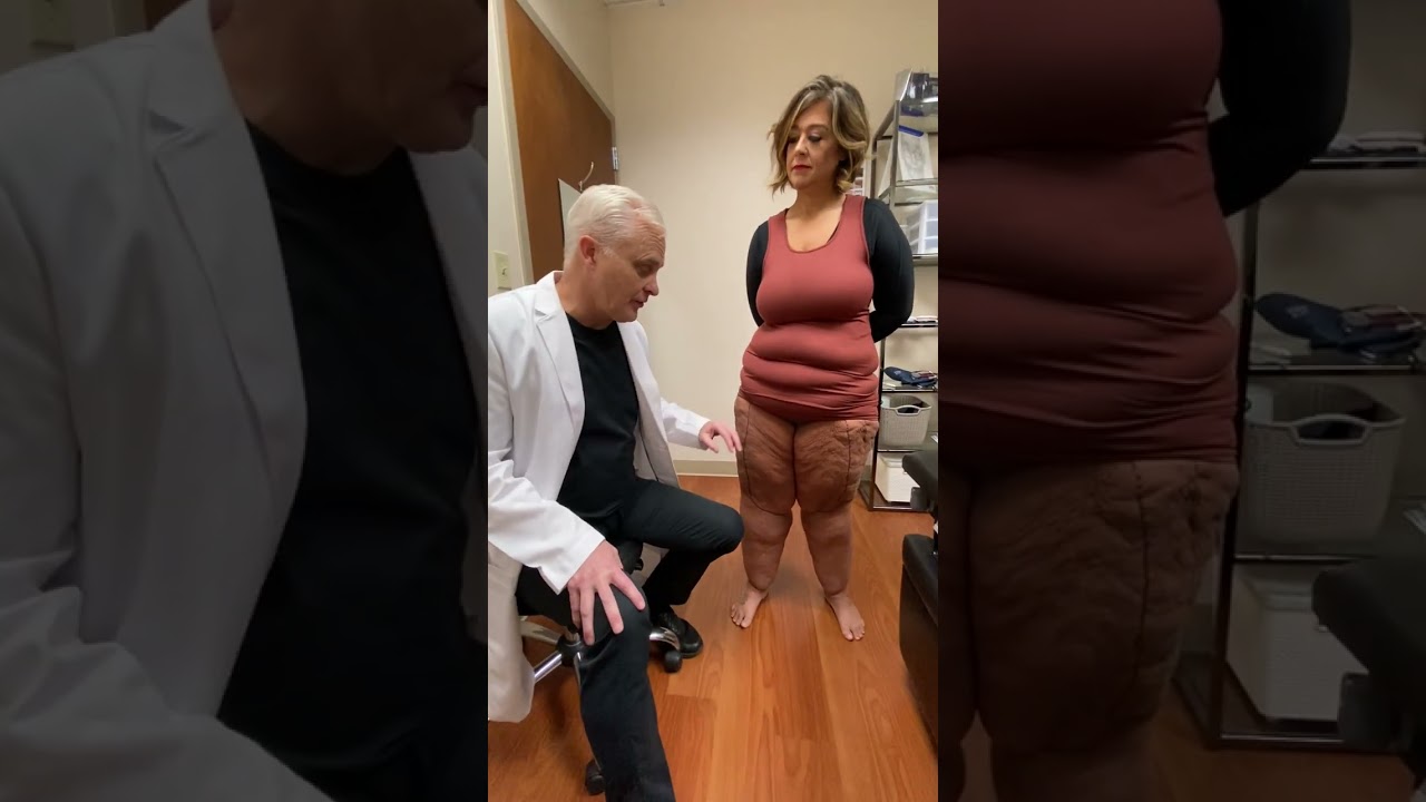 Dr Wright shows leg lobules on a Type 3 Stage 3 Lipedema discusses treatment of lipedema lobules
