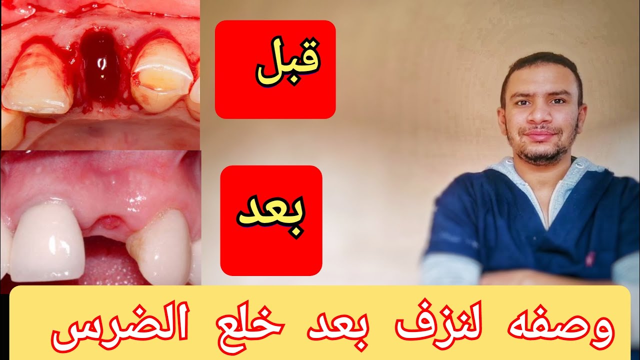 كيف تمنع الدم نهائيا بعد خلع الضرس خلال ٢٠ دقيقه