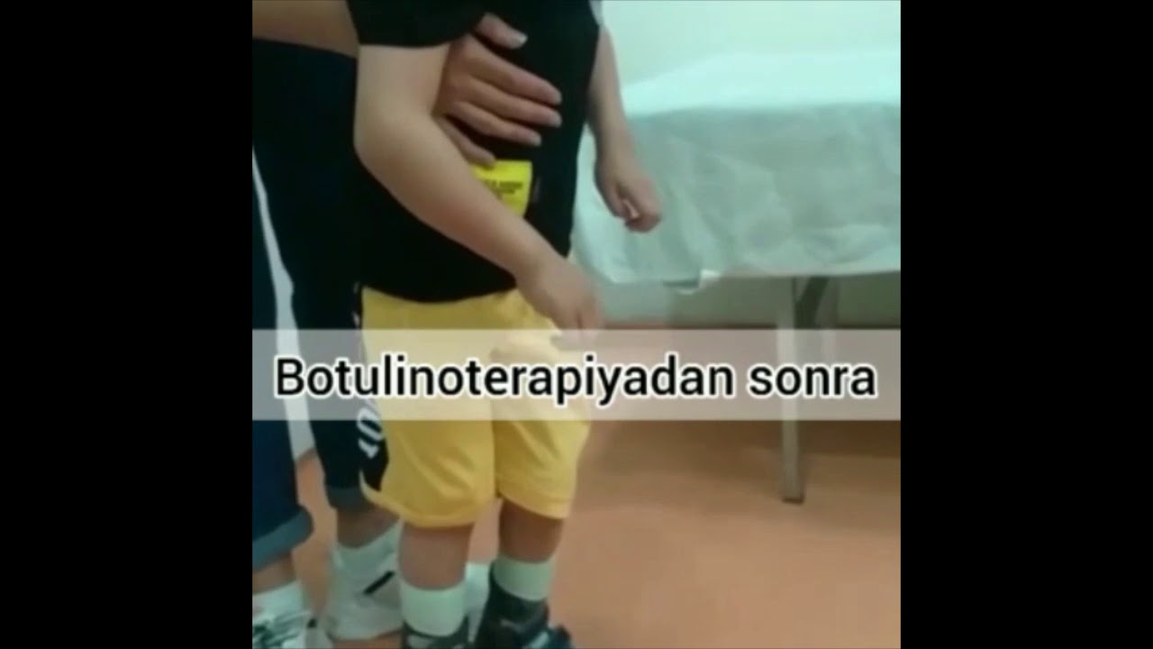 Serebral iflic spastik diplegiya