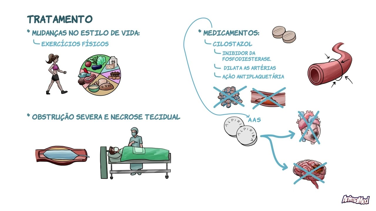 Doença Arterial Periférica (DAP) | AnimaMED Ciclo Básico