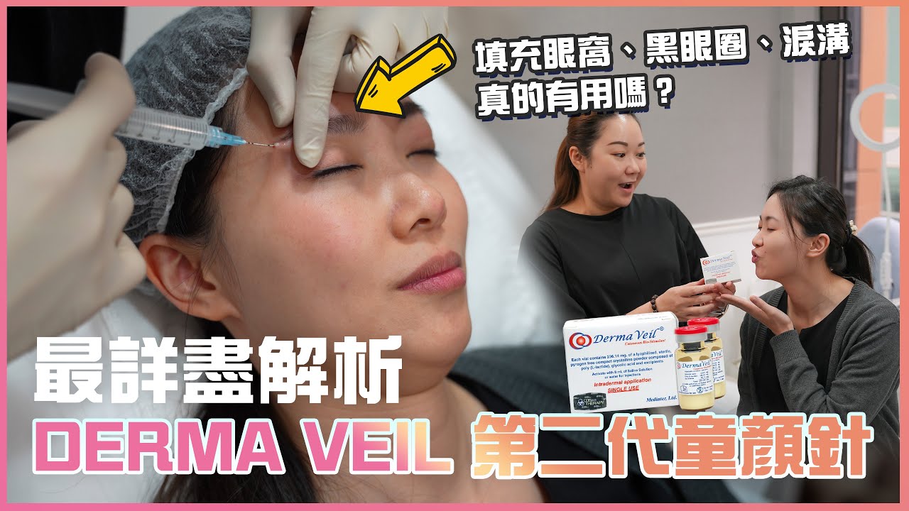 Derma Veil 第2代童顏針｜想改善黑眼圈、淚溝問題一定要選它？｜素人實測在「眼皮上0.1cm」注射全過程！填充眼窩真的很驚險嗎？技術難度滿分！｜與您全方位解釋 #medskinhk