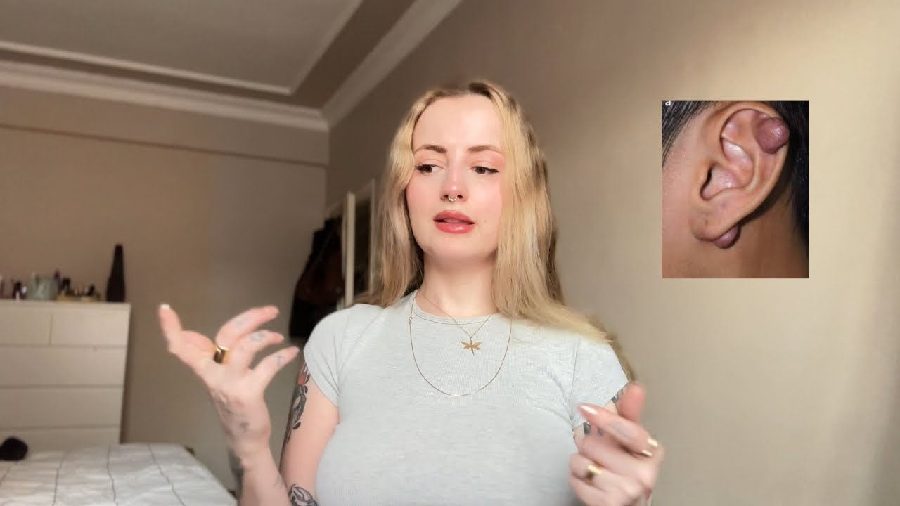 Piercing Keloidi ve Çözümü ✨
