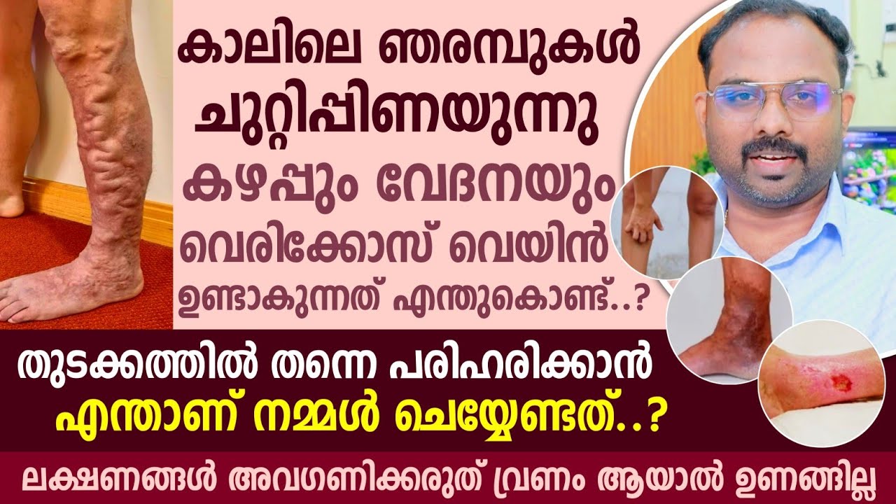 വെരിക്കോസ് വെയിൻ ഉണ്ടാകാൻ കാരണം എന്ത് ? ഇത് പൂർണമായി മാറുമോ ? Varicose vein Causes and Treatment 