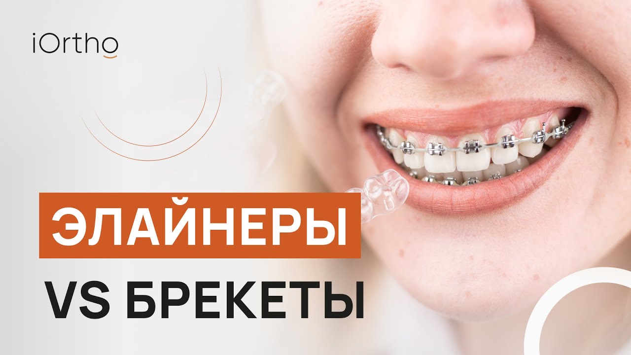 🔎 Элайнеры или брекеты: что лучше?
