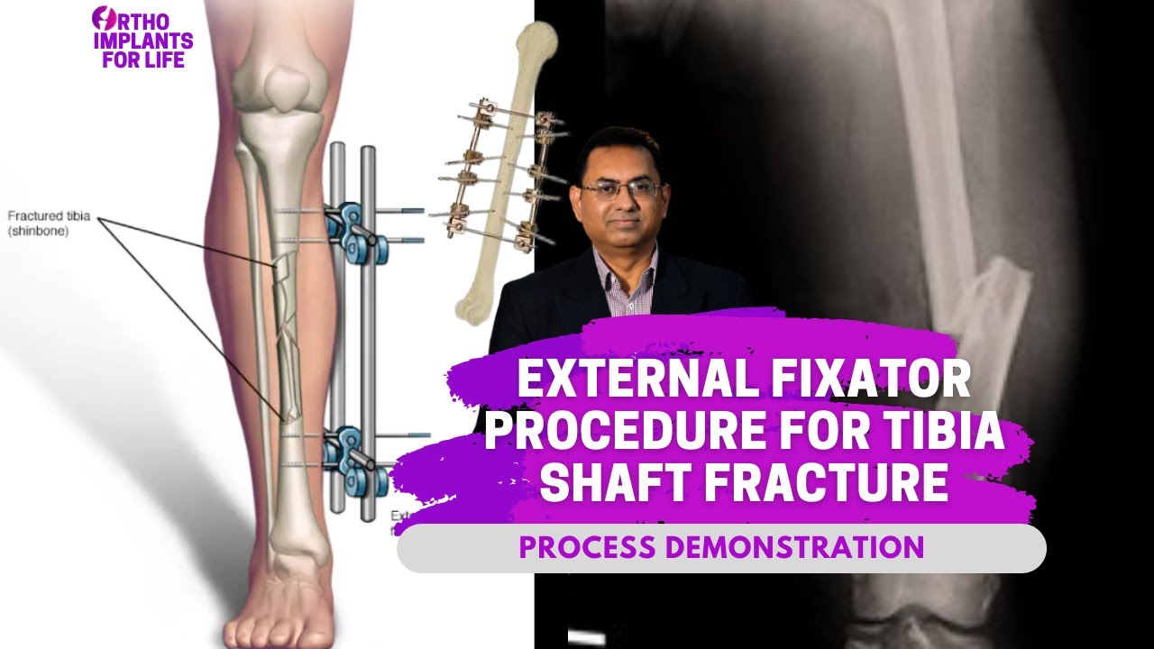 External Fixator Procedure For Tibia Shaft Fracture
