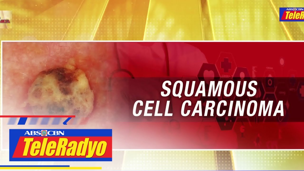 Alamin ang mga sanhi at kung paano maiiwasan ang squamous cell carcinoma | Lingkod Kapamilya