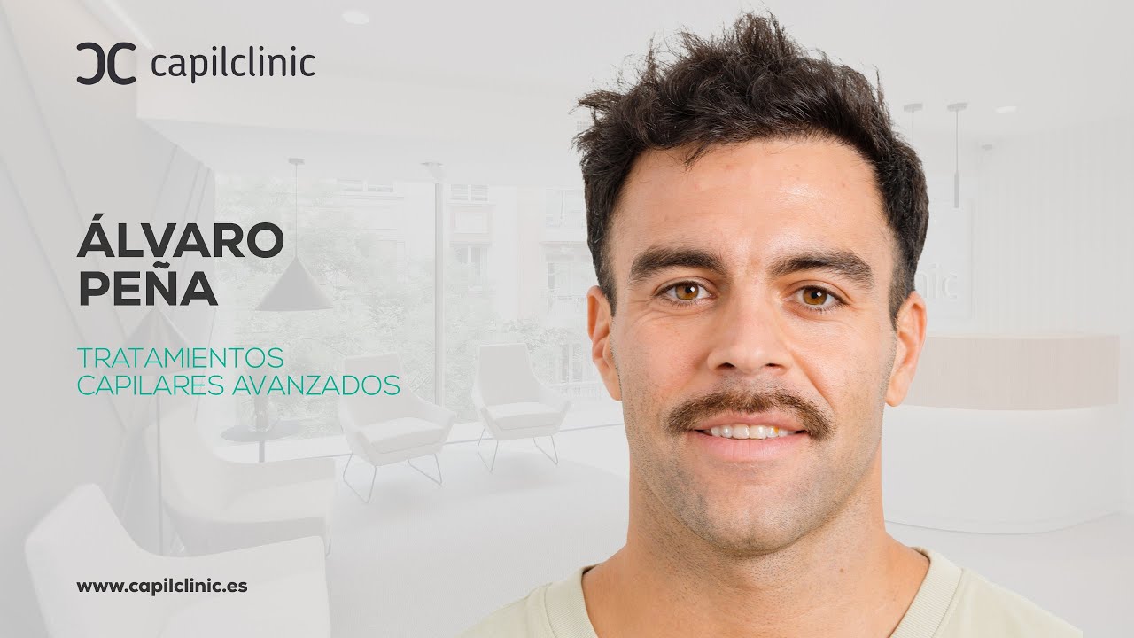 Injerto capilar Madrid | Mi experiencia y resultado #Capilclinic