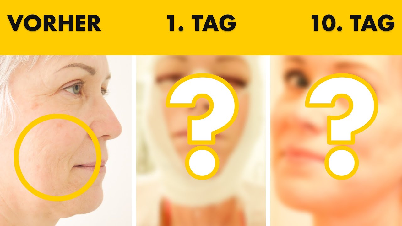 Facelift 4 in 1 OP mit 55 Jahren: JEDEN TAG ein Foto dokumentiert | Heilungsverlauf | Dr. Jungwirth