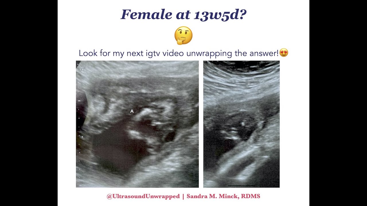 Wrong Gender at 13w5d | Ultrasound Unwrapped