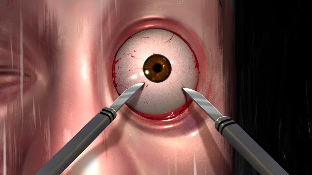 Bob & Wade React To Mark's Eye Surgery