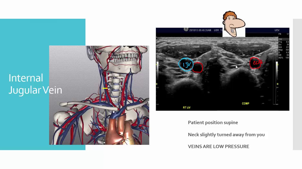 Upper Extremity Venous tutorial1