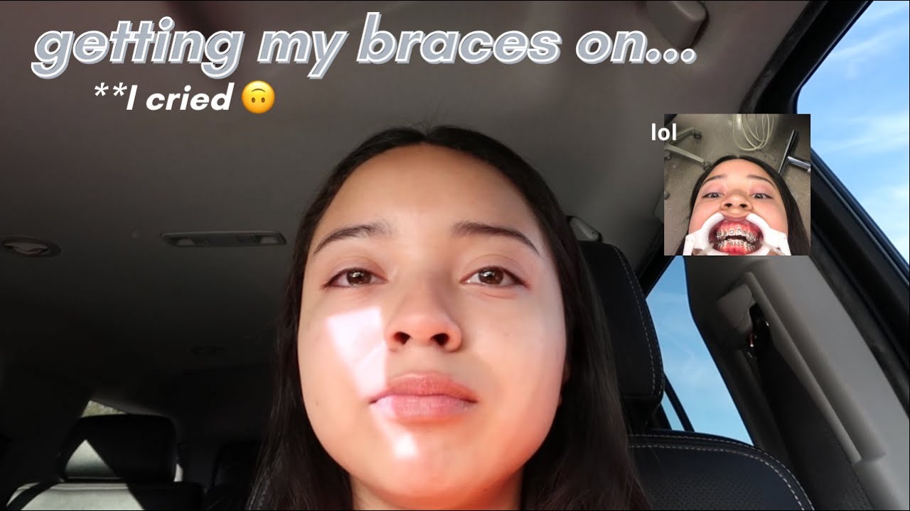 VLOG 10: I got braces lol