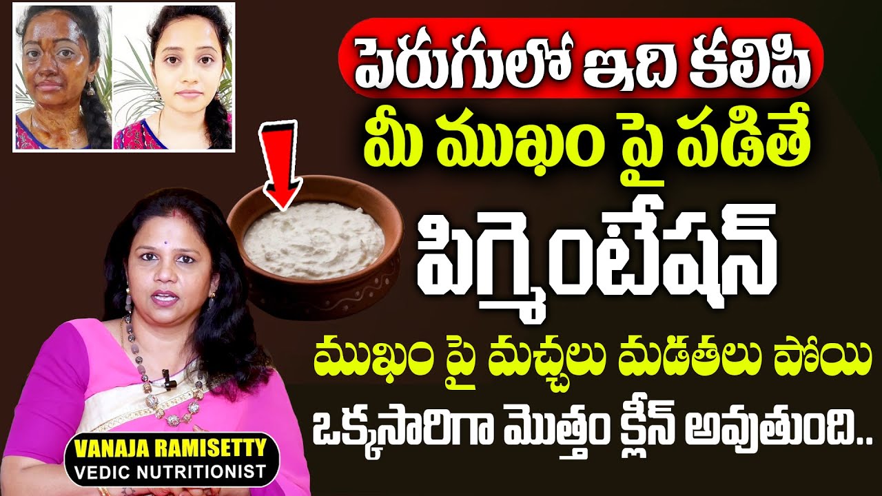 పెరుగుతో ముఖం పై పిగ్మెంటేషన్ మచ్చలు మడతలు అన్ని పోతాయి.. | Pigmentation Get Rid | Vanaja Ramisetty