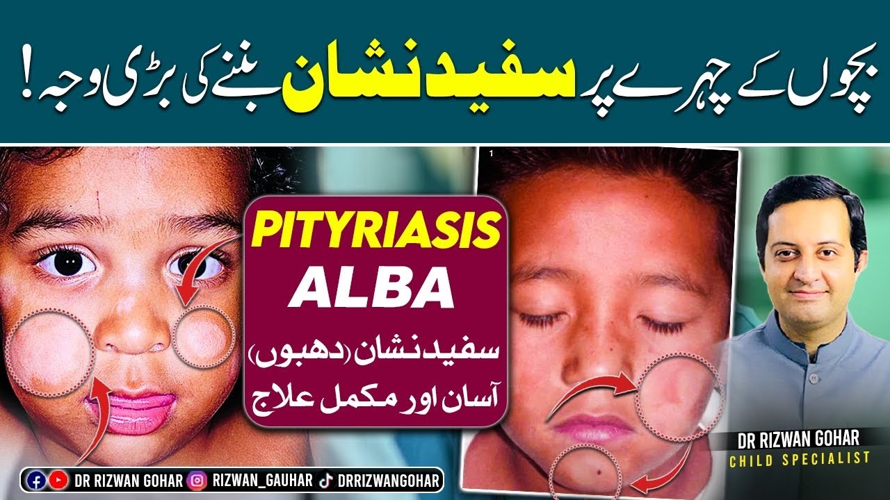 Get Rid of White Spots on Face Forever  | ! 