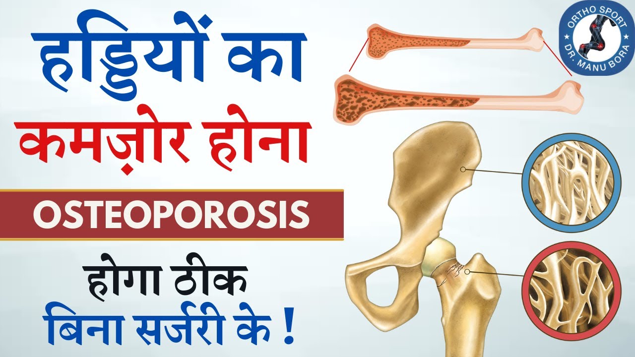 हड्डियों का कमज़ोर होना Osteoporosis ऐसे ठीक करें Osteopenia, Osteoporosis Treatment बिना सर्जरी के