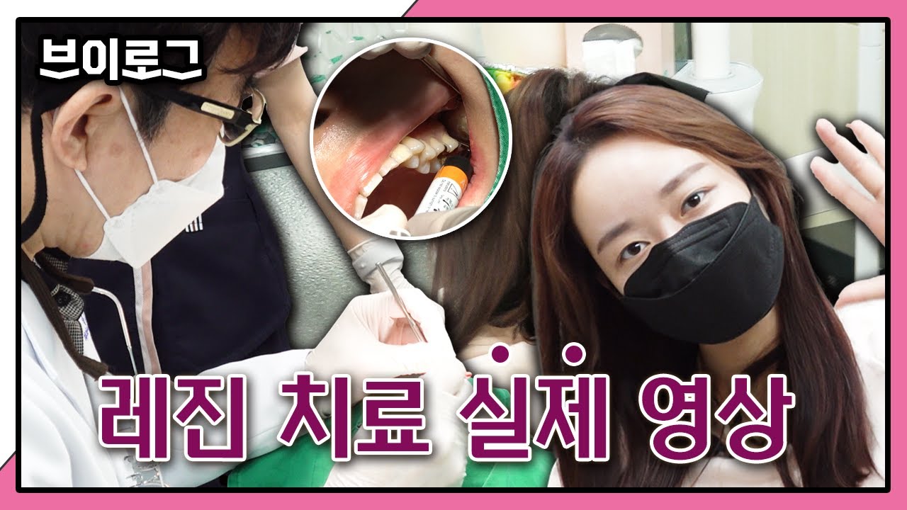 [치과치료 vlog] 레진 치료 실제 영상 / 22세기치리