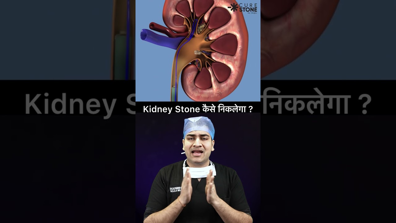 Which Kidney Stone Surgery is Best? 😨 (RIRS vs PCNL vs Lithotripsy)