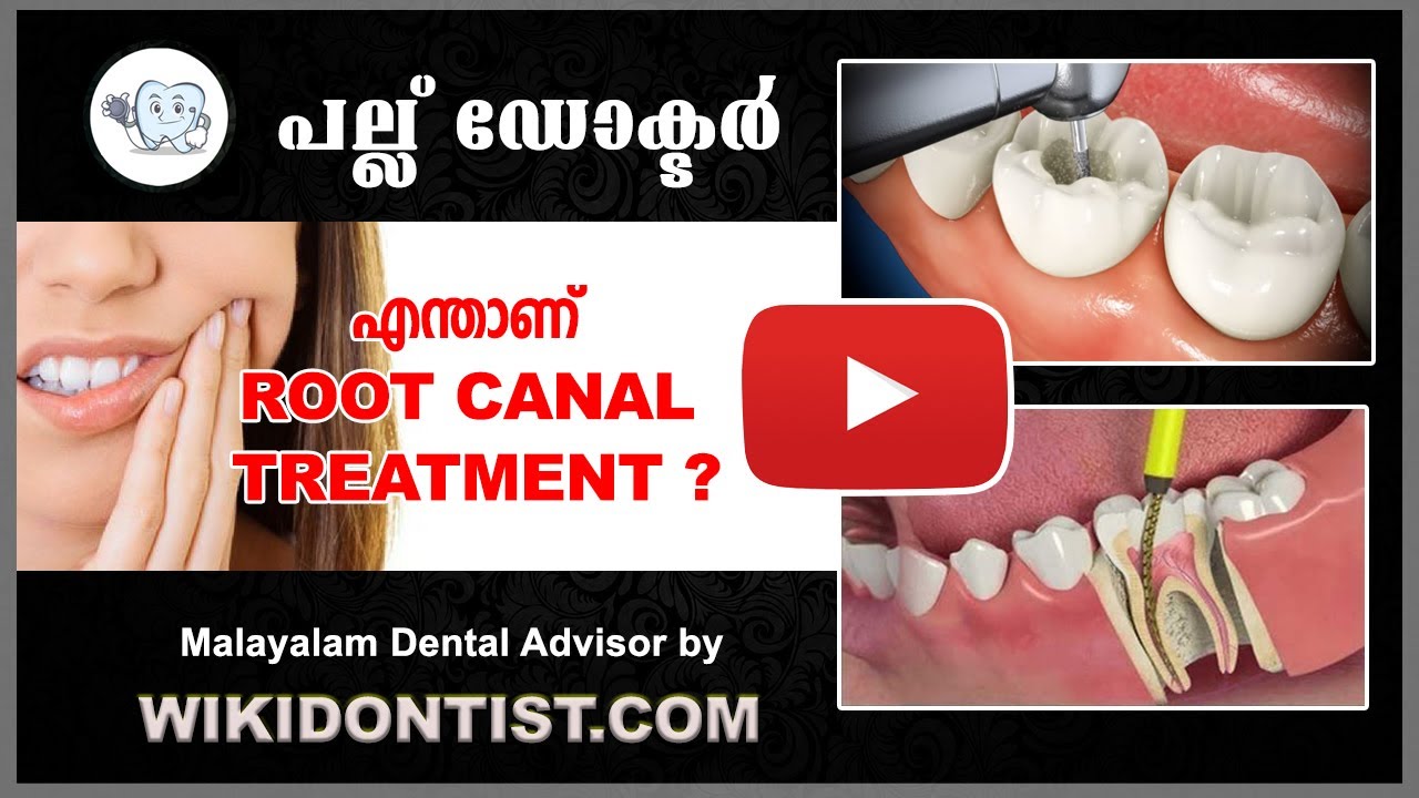 What is a root canal? / Root Canal / #shorts