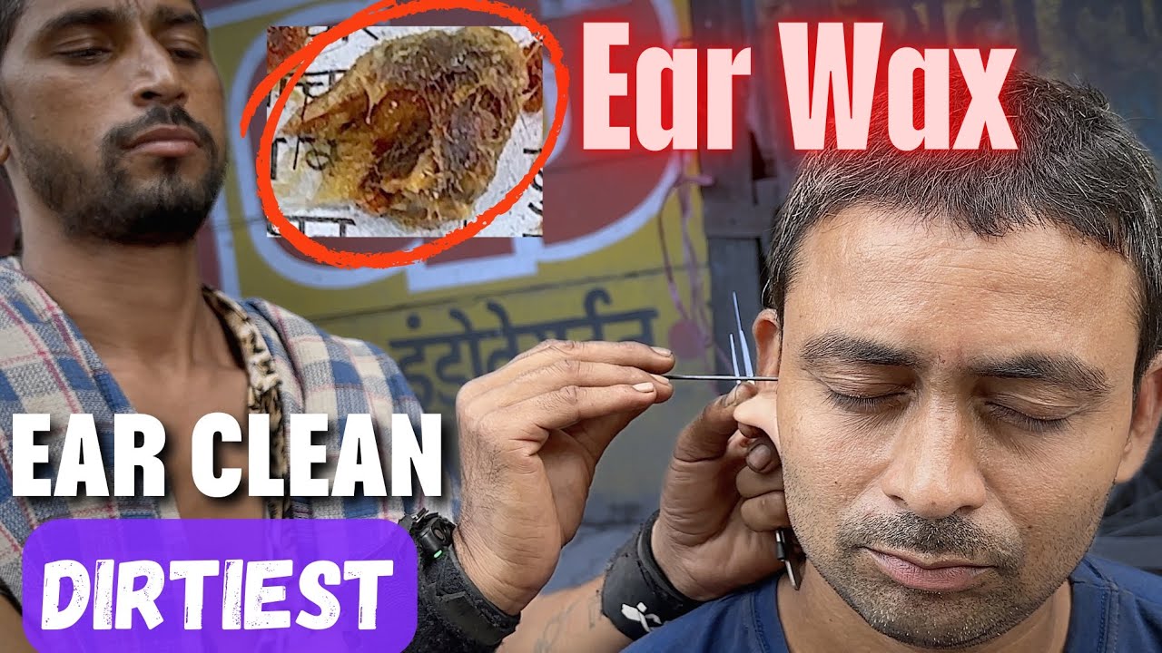 Dirtiest Ear Wax found During Ear Cleaning at Street Side Ear Cleaner | ASMR