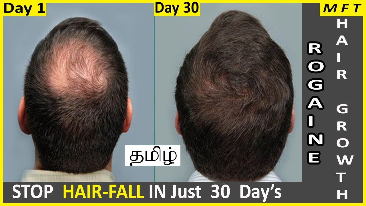 Rogaine Minoxidil for Hair Regrowth in 30 days | Where to buy Rogaine in India | Mens Fashion Tamil