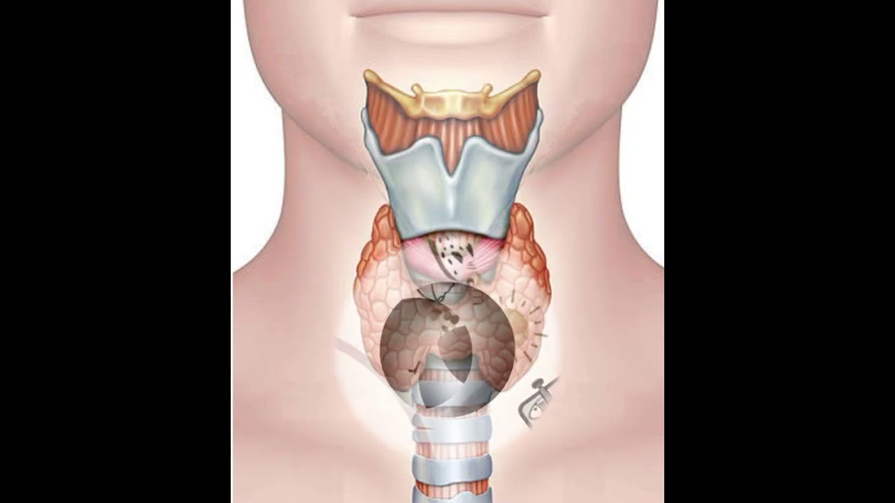 خمول #الغدة ( Hypothyroïdie# ) يزيد #الوزن، يهبّط الطاقة، صحة وتغذية مع كوتش سعاد. 