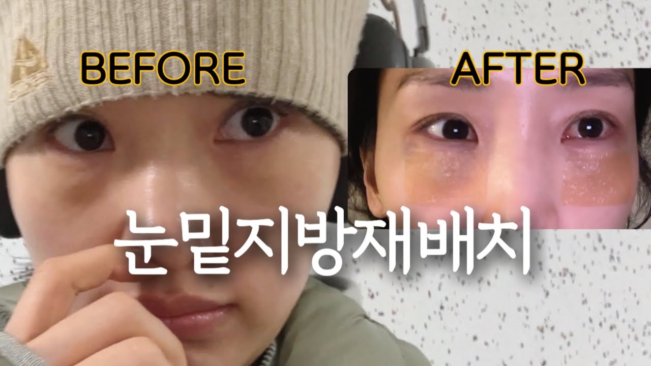 눈밑지방재배치 수술 리얼 후기💉🩸 | 붓기, 통증, 한관종 레이저 시술까지!!