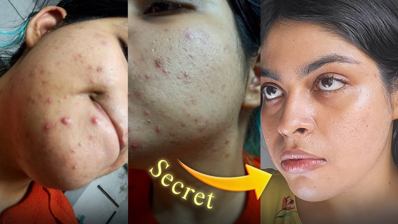 How I CLEARED my ACNE with 1 SECRET Ingredient (NOT Retinol)