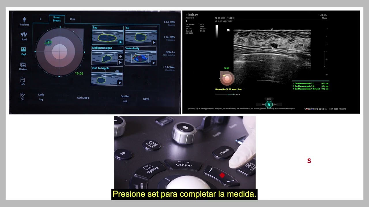 Smart Breast Resona i9