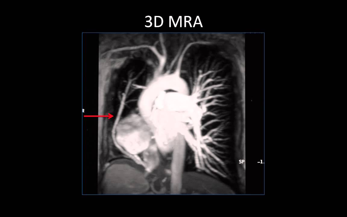 Challenges Imaging Adults with Congenital Heart Disease
