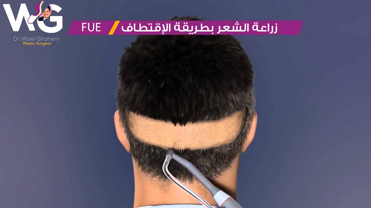 FUE  زراعة الشعر بالإقتطاف كأحدث تقنية لـ زراعة الشعر
