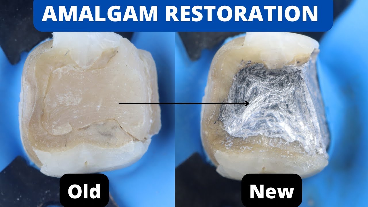 Amalgam Restoration 🟢 Replacing Old Restoration with New One ⚪️