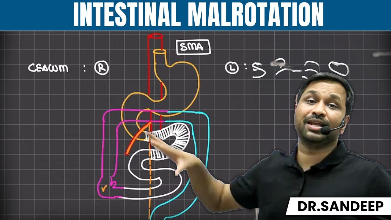 Intestinal Malrotation | Surgery | Bailey learned with Dr. Sandeep